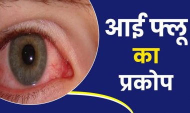 आईफ्लू से बचाव के लिए रखे विशेष सावधानी— चिकित्सा विभाग ने सभी सीएमएचओ एवं पीएमओ को जारी किये दिशा-निर्देश